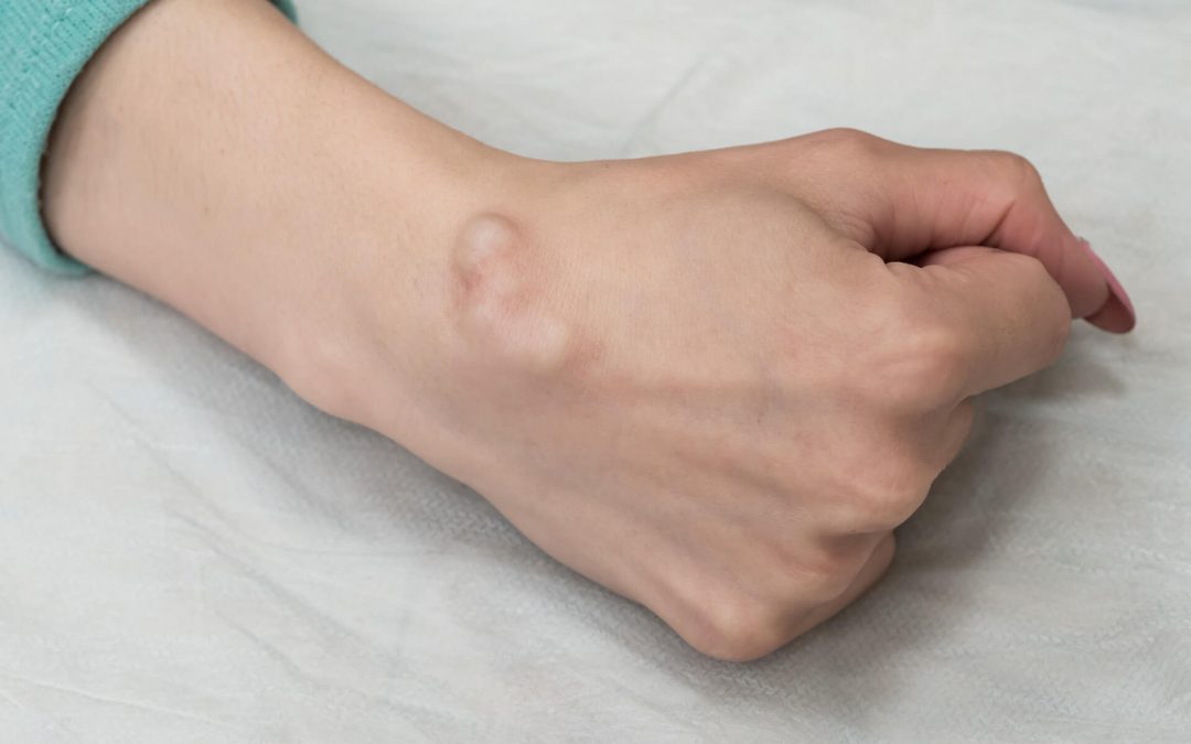 Kyste arthro-synovial - Imppact - Chirurgie de la main et du pied ...